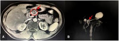 Case report: Treatment of intraductal papillary mucinous neoplasms located in middle-segment pancreas with end-to-end anastomosis reconstruction after laparoscopic central pancreatectomy surgery through a pigtail-tube-stent placement of the pancreatic duct